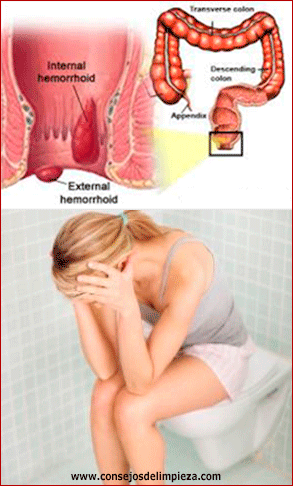 hemoorides-internas-o-externas