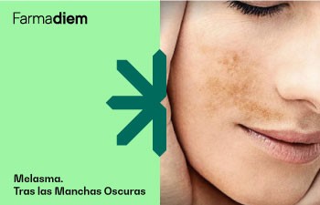 Melasma: La Afección Cutánea de las Manchas Oscuras