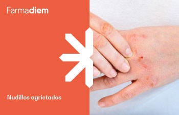 Nudillos agrietados: causas y remedios para tratarlos